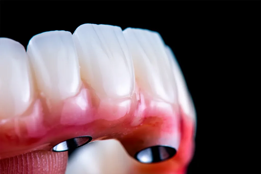 dental photography of full arch zircon bridge on implants